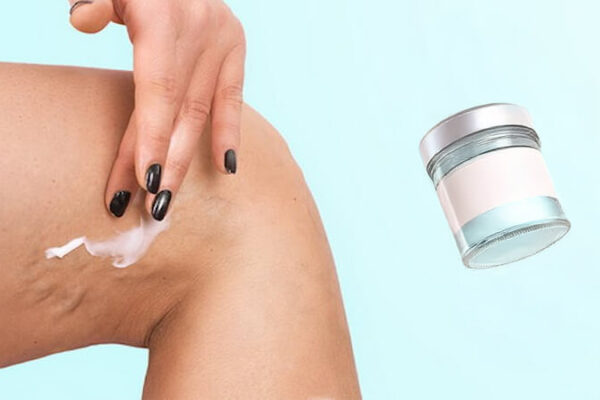 Benarkah-Varises-Bisa-Sembuh-dengan-Salep-atau-Pijat