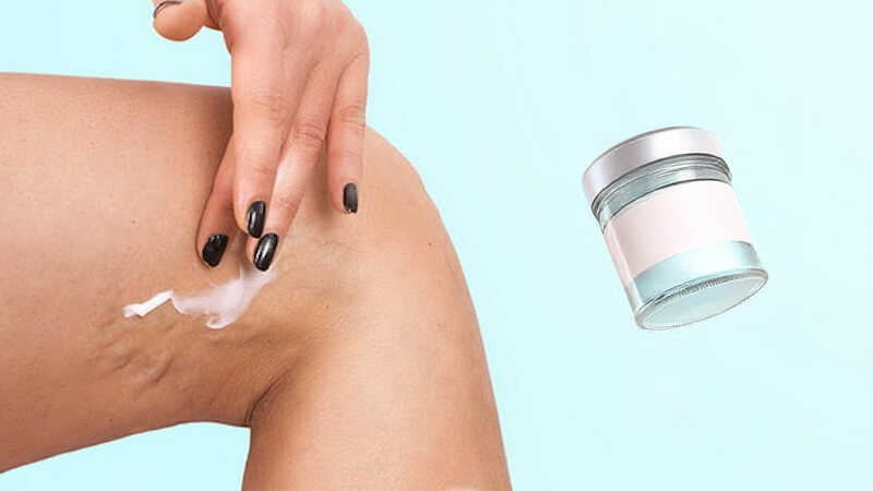 Benarkah-Varises-Bisa-Sembuh-dengan-Salep-atau-Pijat