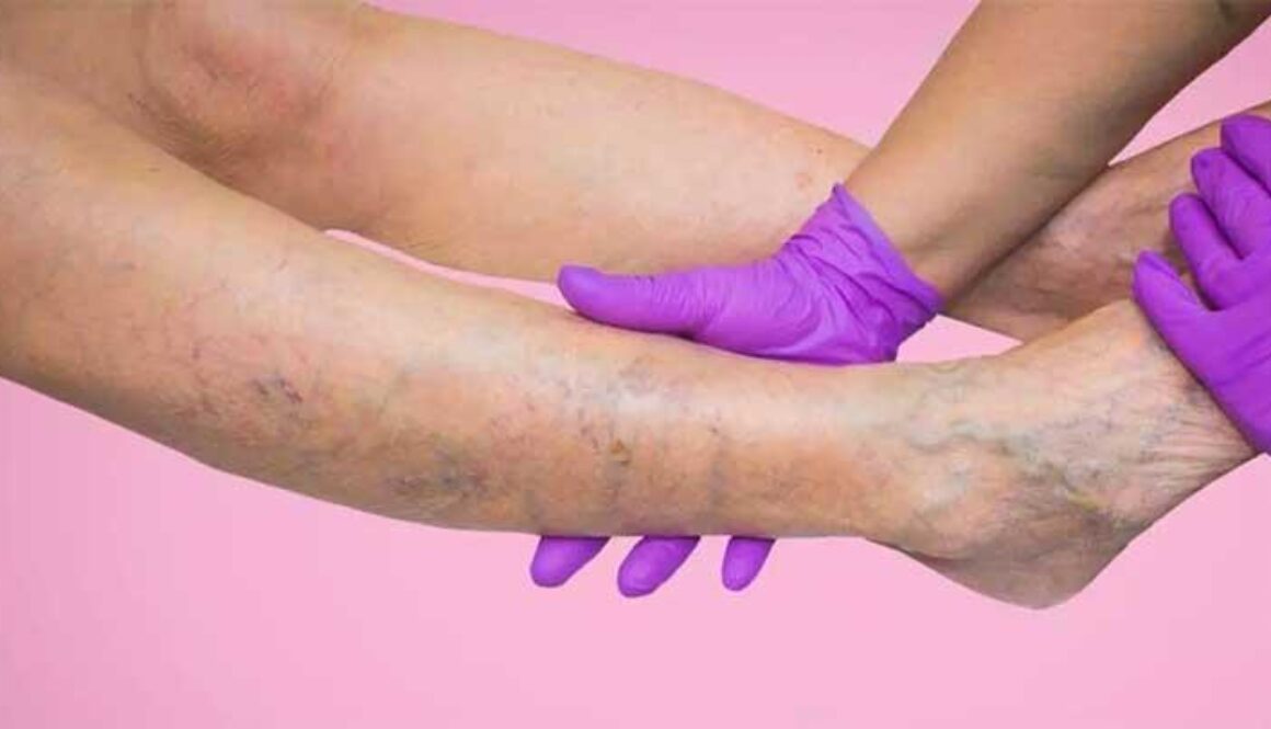 Cara-Mencegah-dan-Menghilangkan-Varises-di-Kaki-Akibat-Sering-Olah-Raga
