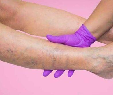 Cara-Mencegah-dan-Menghilangkan-Varises-di-Kaki-Akibat-Sering-Olah-Raga