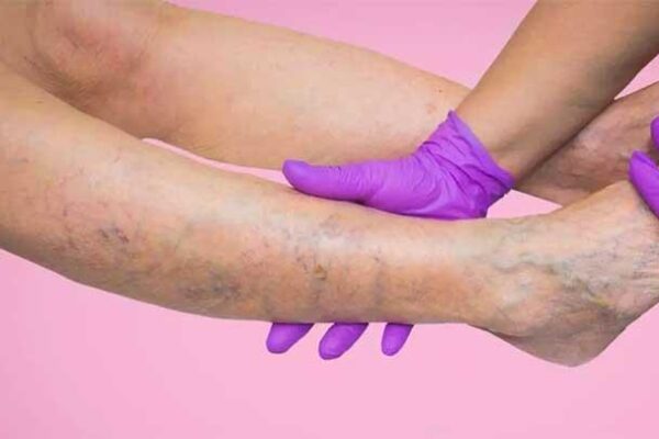 Cara-Mencegah-dan-Menghilangkan-Varises-di-Kaki-Akibat-Sering-Olah-Raga