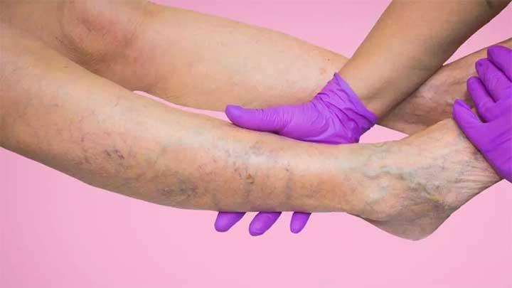 Cara-Mencegah-dan-Menghilangkan-Varises-di-Kaki-Akibat-Sering-Olah-Raga